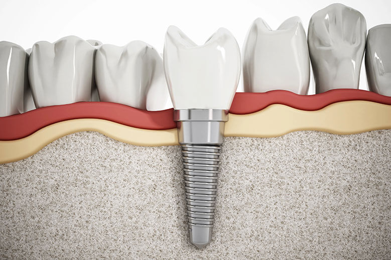 Implants vs. Dentures Cost: Which Is Cheaper